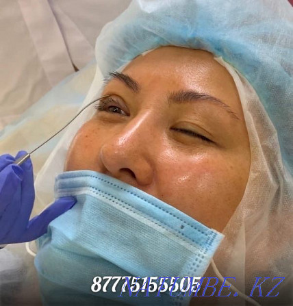 Eyelid blepharoplasty with Sangapuri threads Atyrau - photo 1