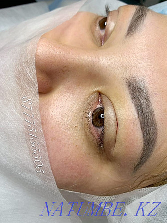 Eyelid blepharoplasty with Sangapuri threads Atyrau - photo 3