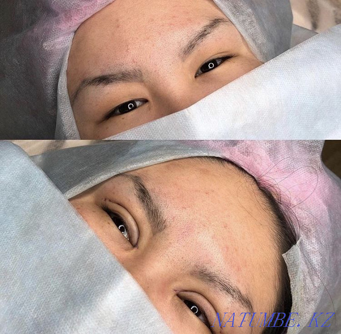 Eyelid blepharoplasty with Sangapuri threads Atyrau - photo 8