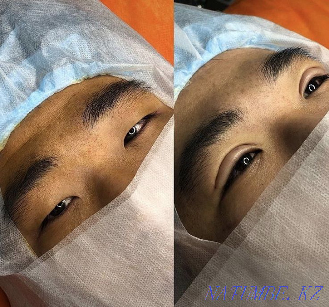 Eyelid blepharoplasty with Sangapuri threads Atyrau - photo 5