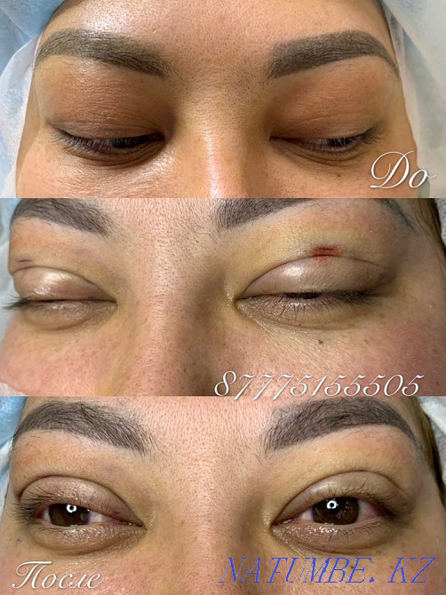 Eyelid blepharoplasty with Sangapuri threads Atyrau - photo 4
