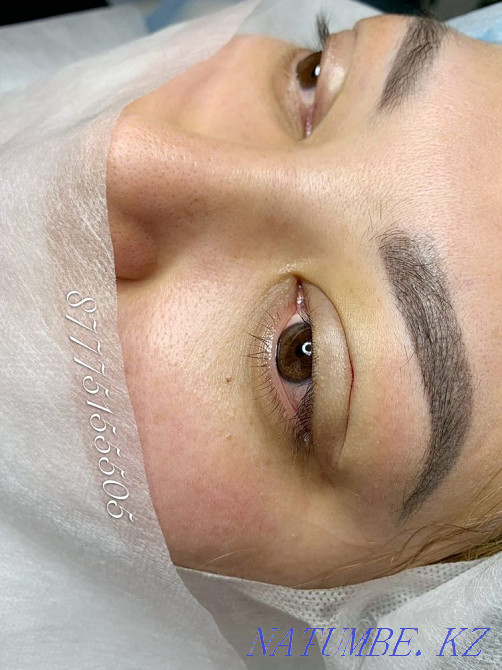 Eyelid blepharoplasty with Sangapuri threads Atyrau - photo 3