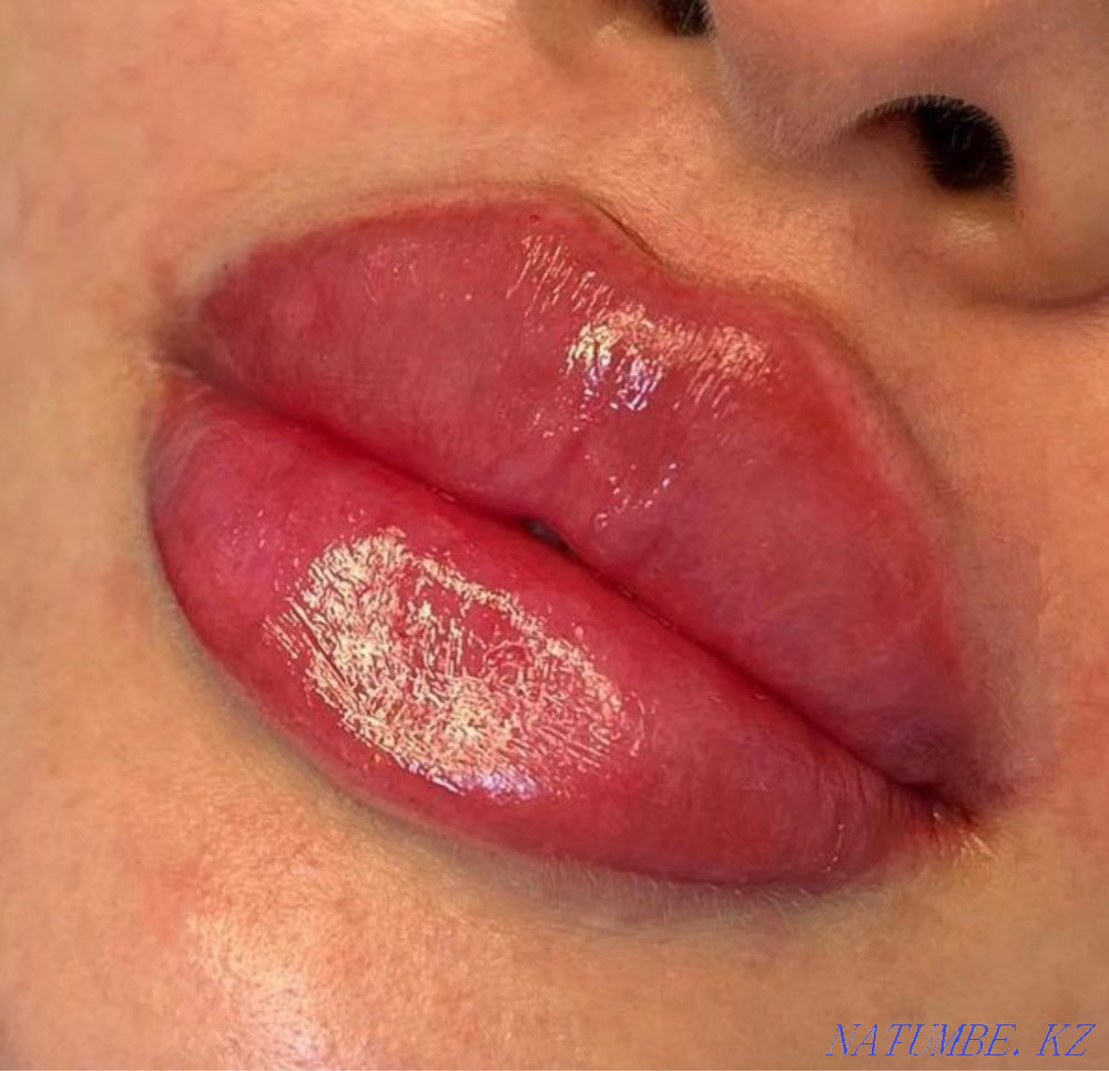 Увеличение губ Атырау - изображение 4