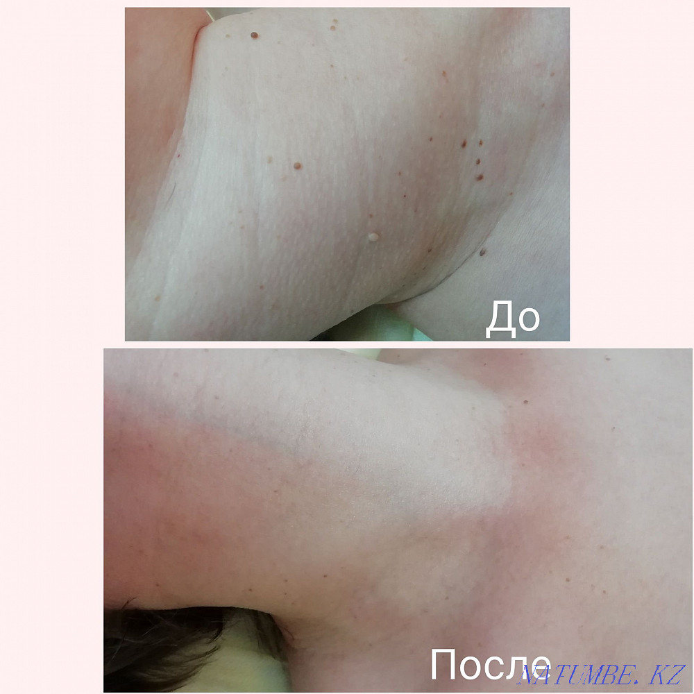 Removal of warts, papillomas, genital warts with liquid nitrogen Karagandy - photo 1