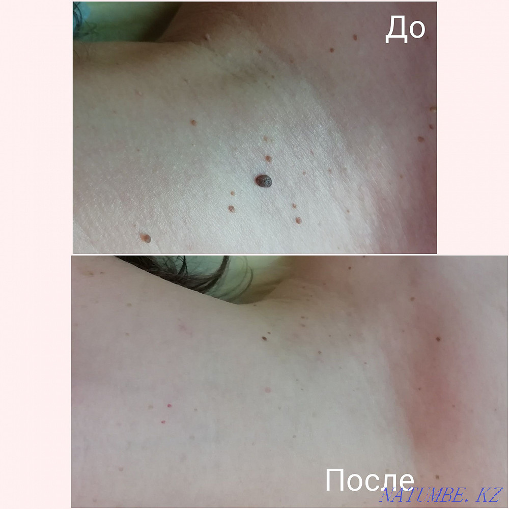 Removal of warts, papillomas, genital warts with liquid nitrogen Karagandy - photo 2