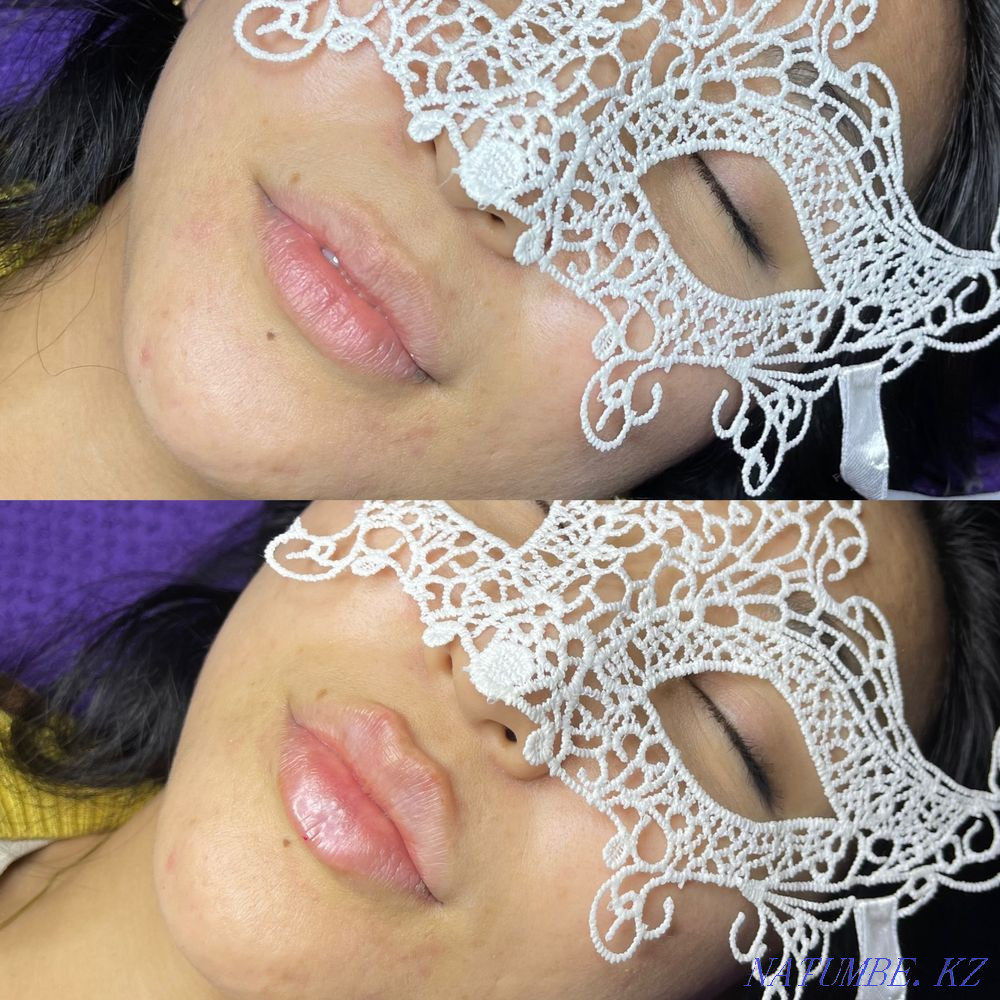 Lip augmentation for 25000 tenge Karagandy - photo 4