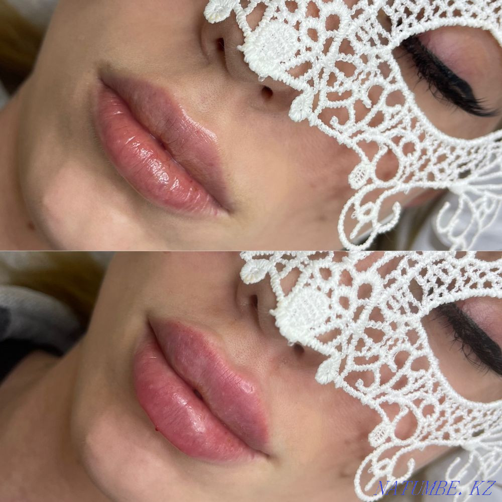 Lip augmentation for 25000 tenge Karagandy - photo 1
