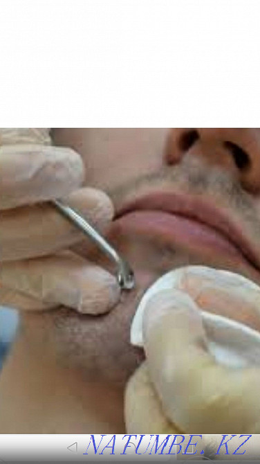 Акция! Мужская чистка лица! 5000 тг Алматы - изображение 1