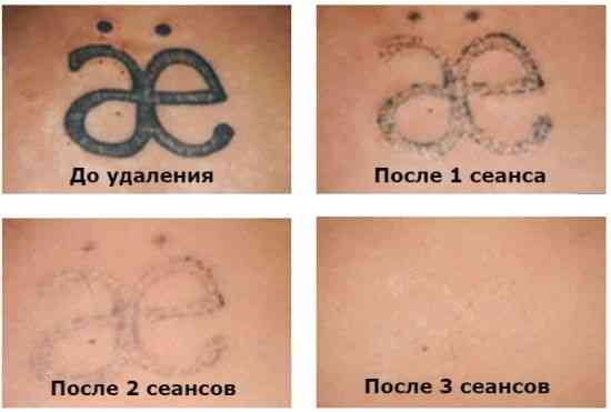 Удаление татуажа от 3000тг. Опыт работы 10лет. Almaty
