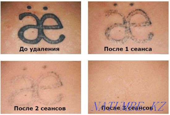 Tattoo removal from 3000tg. Experience 10 years. Almaty - photo 3