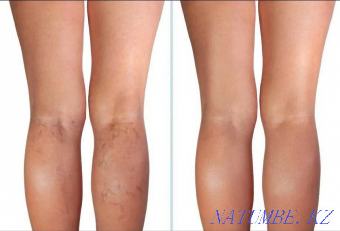 Removal of spider veins on the legs. Sclerotherapy FOAM-FORM Astana - photo 1