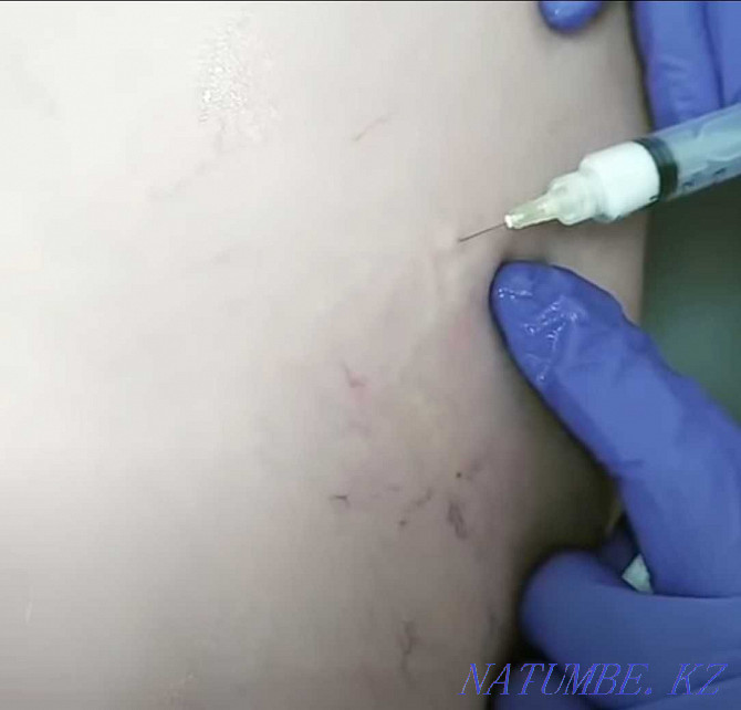 Removal of spider veins on the legs. Sclerotherapy FOAM-FORM Astana - photo 4