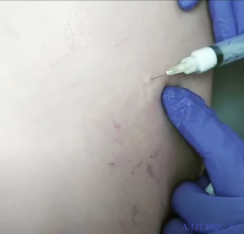 Удаление сосудистых звёздочек на ногах. Склеротерапия FOAM-FORM Астана - изображение 4