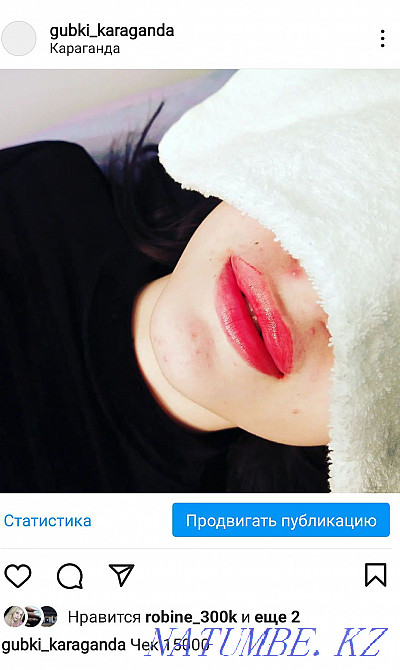 Lip augmentation. Contour plastic. Karagandy - photo 2