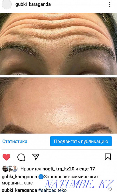 Lip augmentation. Contour plastic. Karagandy - photo 6