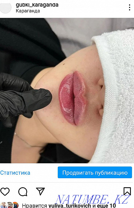 Lip augmentation. Contour plastic. Karagandy - photo 5
