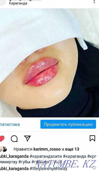 Lip augmentation. Contour plastic. Karagandy - photo 1