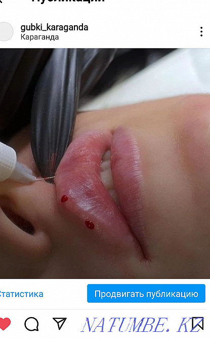 Lip augmentation. Contour plastic. Karagandy - photo 3