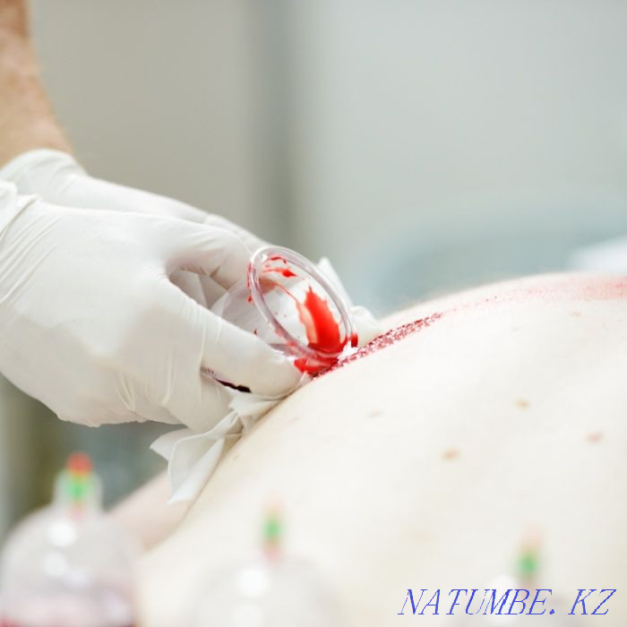 Гирудотерапия(Пиявки).Апитерапия Туркестан - изображение 6