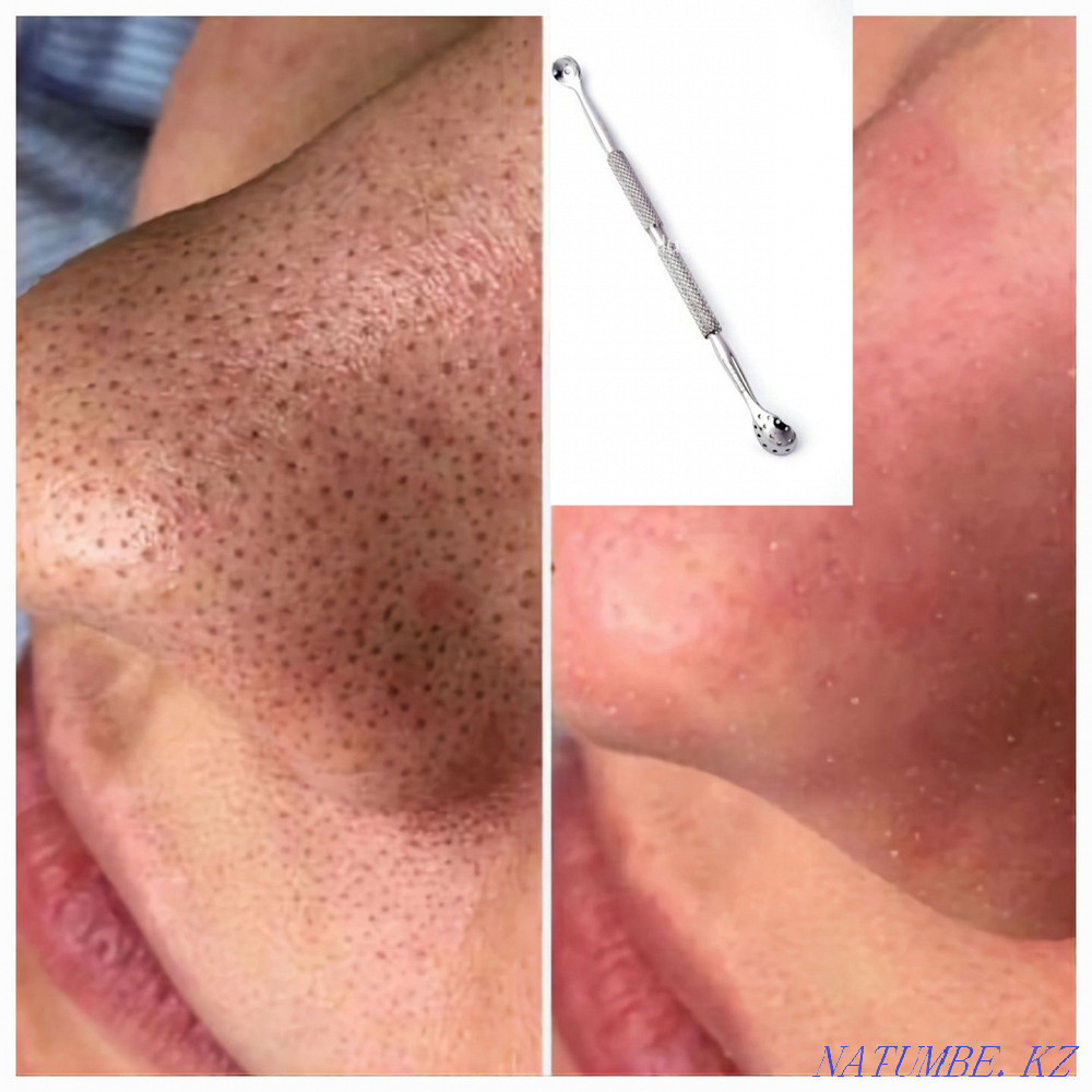 Увеличение губ. Контурная пластика Бесагаш - изображение 3