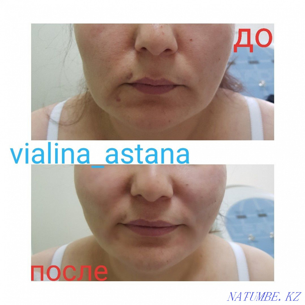Смас лифтинг smas lifting омоложение подтяжка Астана - изображение 4