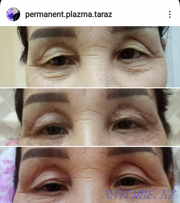 Plasmalift wrinkle lift  - photo 3