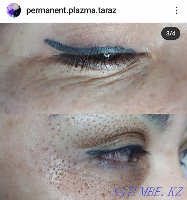 Plasmalift wrinkle lift  - photo 1