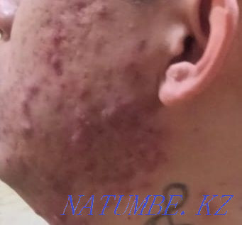 Акция!чистка лица 8000 вместо 15000 Алматы - изображение 3