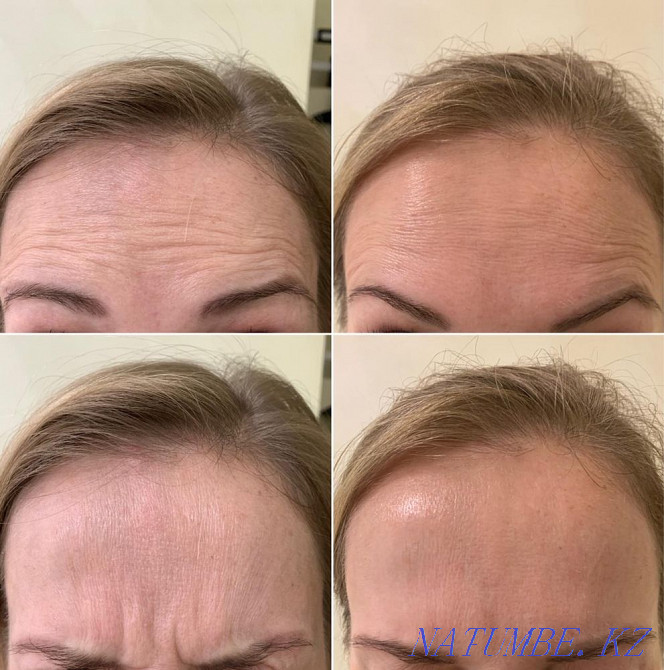 Botox action 1 unit 800 tg Temirtau - photo 6