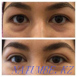 Thread blepharoplasty for the promotion 20.000tg Almaty - photo 1