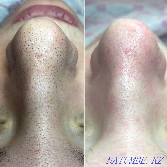 Facial cleaning for a promotion of 5000tg Almaty - photo 1