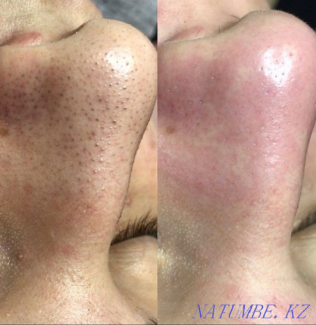 Facial cleaning for a promotion of 5000tg Almaty - photo 3