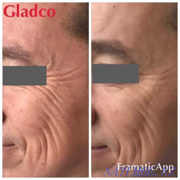 Ботокс / Диспорт / Әжімді тегістеу / Ерін үлкейту / АКЦИЯ  Алматы - изображение 3