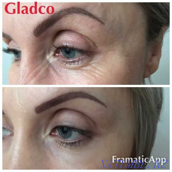 Ботокс / Диспорт / Әжімді тегістеу / Ерін үлкейту / АКЦИЯ  Алматы - изображение 2