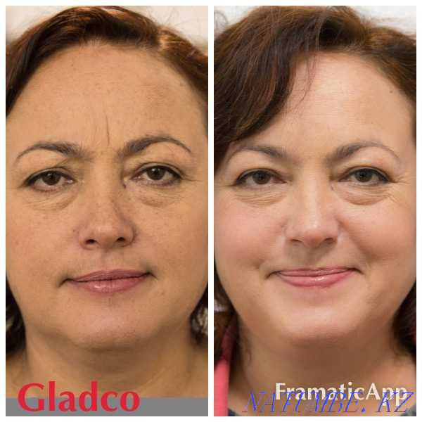 Ботокс / Диспорт / Әжімді тегістеу / Ерін үлкейту / АКЦИЯ  Алматы - изображение 1