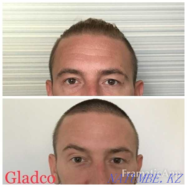 Ботокс / Диспорт / Әжімді тегістеу / Ерін үлкейту / АКЦИЯ  Алматы - изображение 6