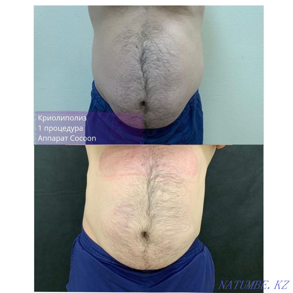 Cryolipolysis. Fat freezing effectively 10000 tenge 2 nozzles Almaty - photo 3