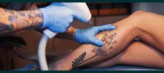 Лазерное удаление татуировок и татуажа  Орал