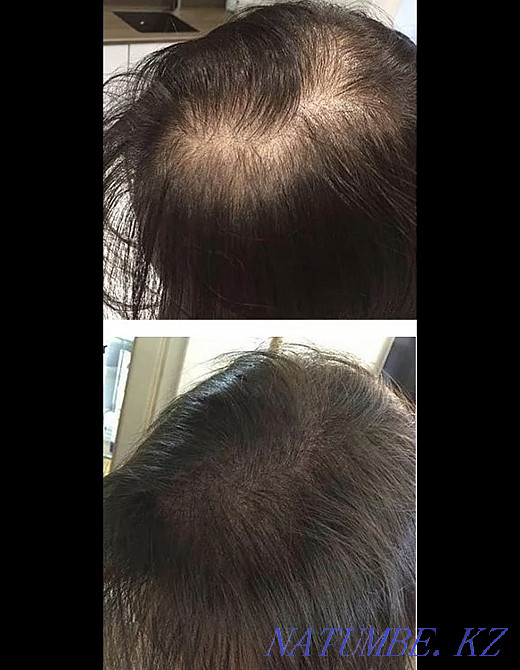 Tricopigmentation (camouflage of bald patches) Petropavlovsk - photo 5