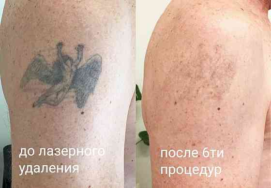 Удаление татуажа бровей губ век татуировок тату ремувер лазер обучение Almaty