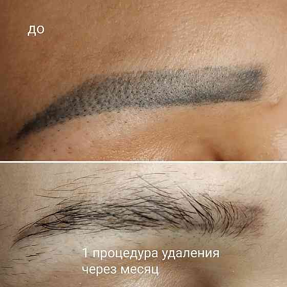 Удаление татуажа бровей губ век татуировок тату ремувер лазер обучение Алматы