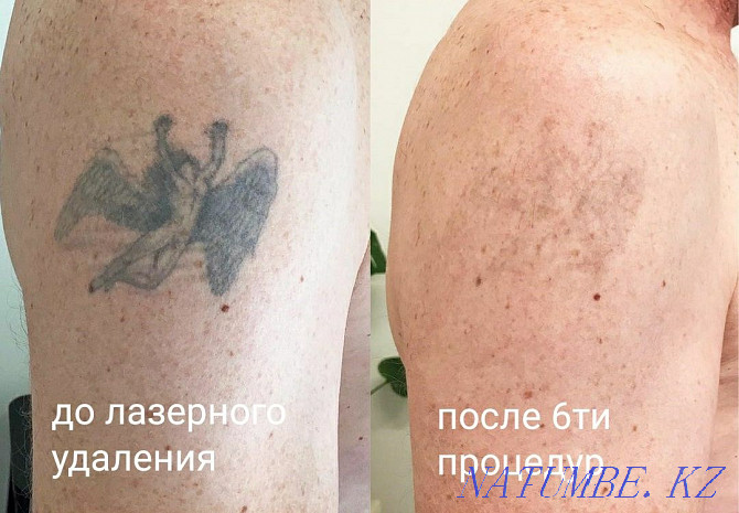 Удаление татуажа бровей губ век татуировок тату ремувер лазер обучение Алматы - изображение 3