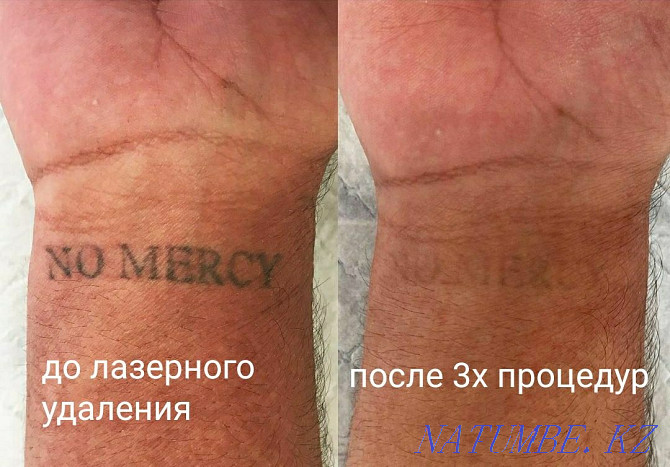 Удаление татуажа бровей губ век татуировок тату ремувер лазер обучение Алматы - изображение 1