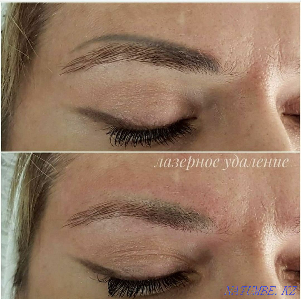 Eyebrow tattoo removal lips eyelid tattoo tattoo remover laser training Almaty - photo 4