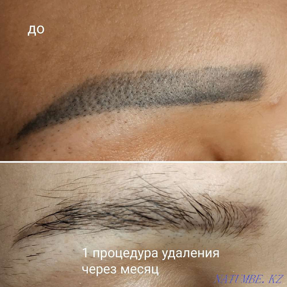 Eyebrow tattoo removal lips eyelid tattoo tattoo remover laser training Almaty - photo 6
