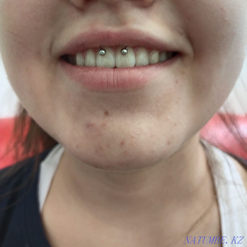 Ear piercing for children from 3 months Petropavlovsk - photo 6