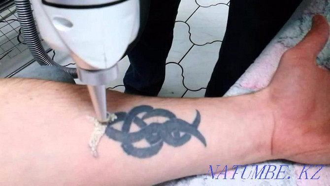 LASER REMOVAL! Tattoos and tattooing of eyebrows!! neodymium laser. Petropavlovsk - photo 5