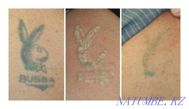 LASER REMOVAL! Tattoos and tattooing of eyebrows!! neodymium laser. Petropavlovsk - photo 7