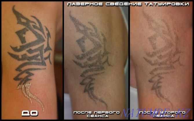 LASER REMOVAL! Tattoos and tattooing of eyebrows!! neodymium laser. Petropavlovsk - photo 4