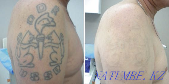 LASER REMOVAL! Tattoos and tattooing of eyebrows!! neodymium laser. Petropavlovsk - photo 6